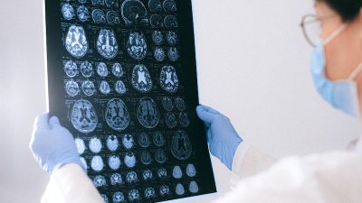 Deneysel ilaç lecanemab, üçüncü aşama